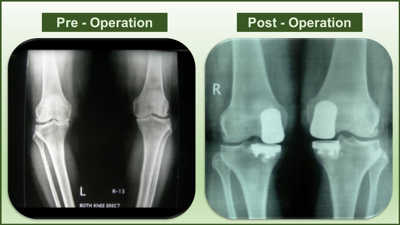 partial knee replacement cost delhi