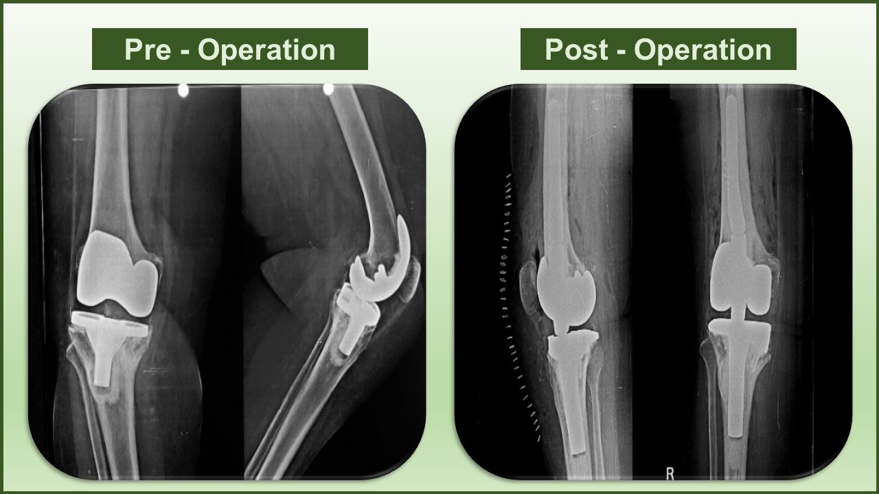 revision surgery