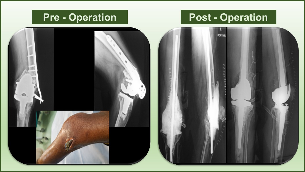 revision knee replacement