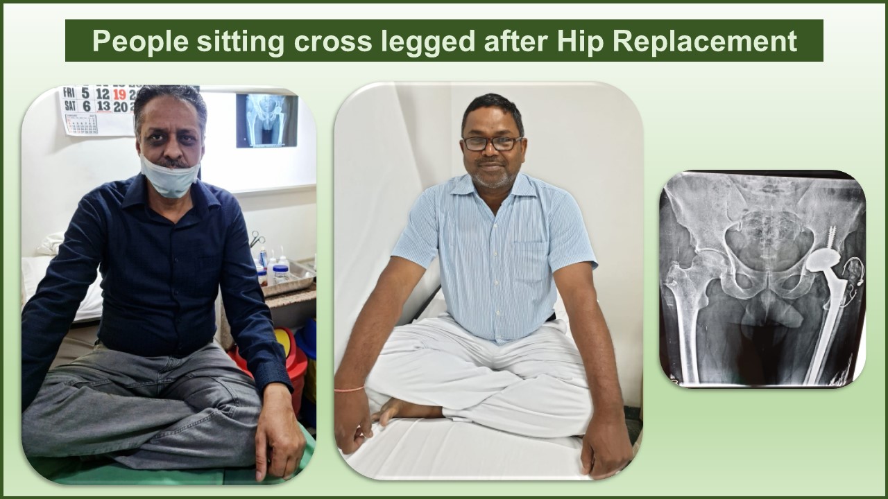 Wearing Out of Total Hip Replacement Surgery