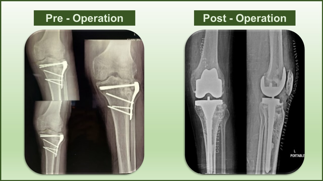 total hip replacement surgery specialist in Delhi