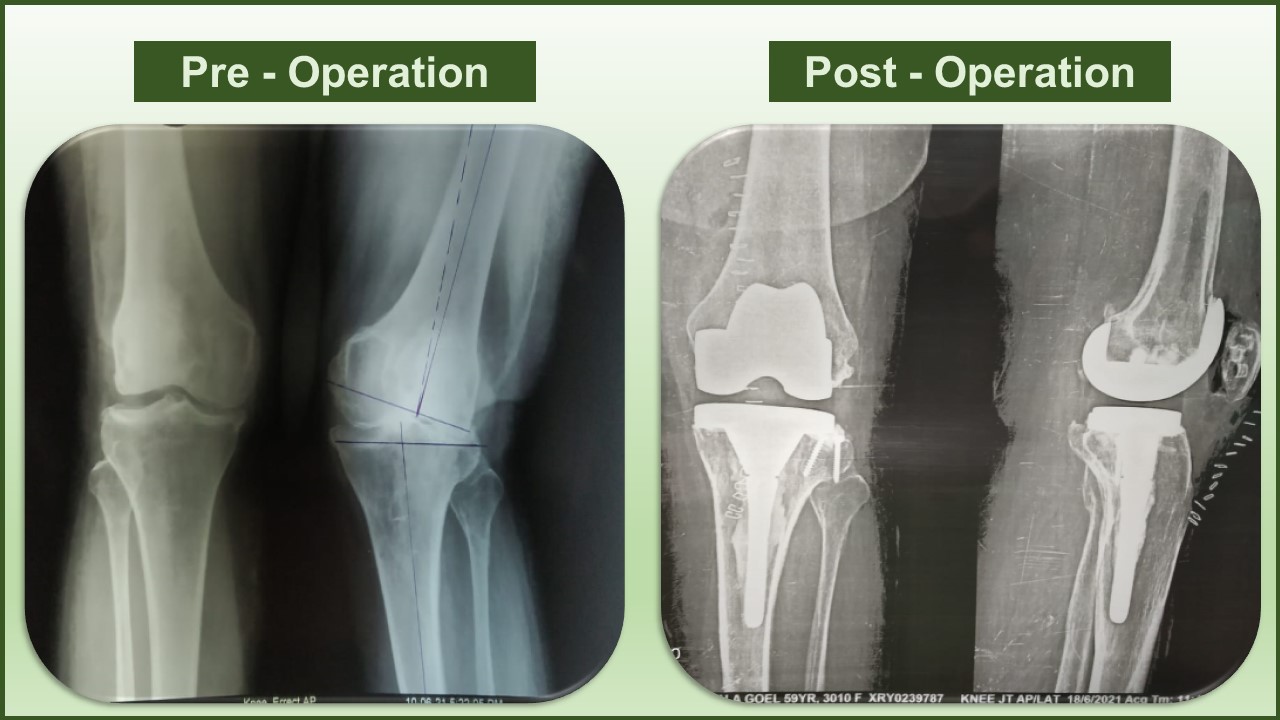total knee replacement surgery doctor in Delhi