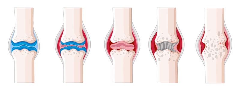 Osteoarthritis specialist delhi