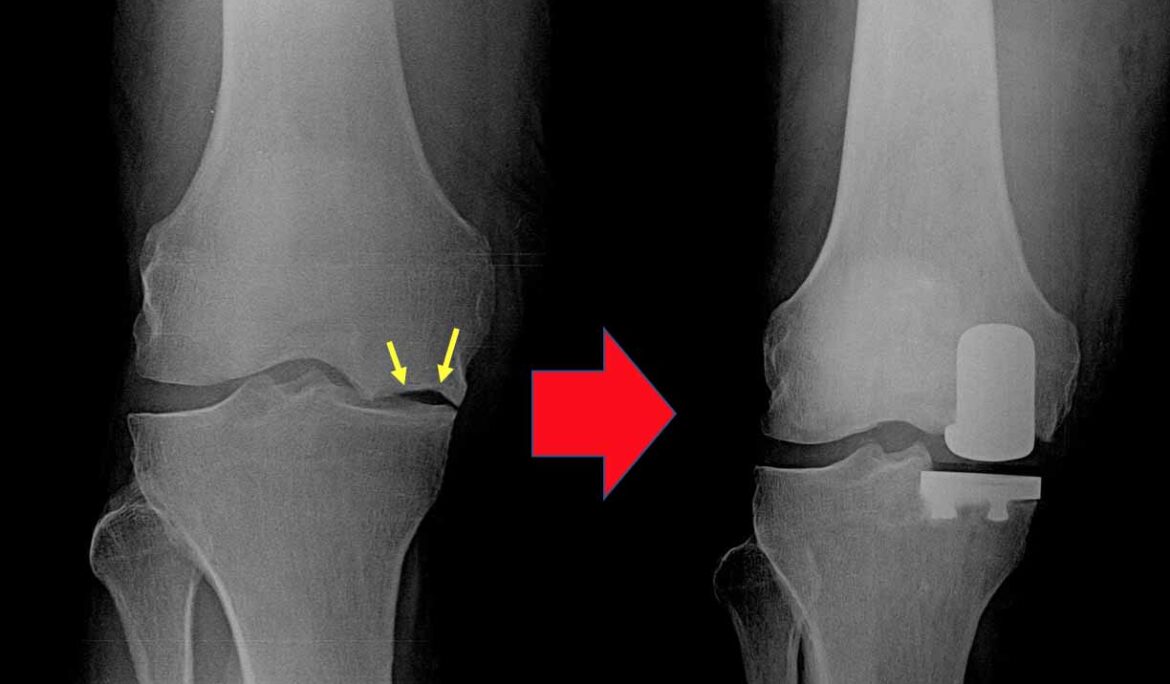 partial knee replacement in Delhi