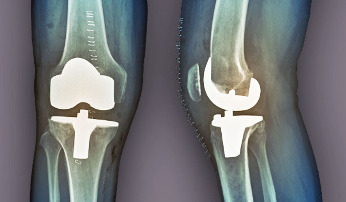 partial knee replacement in Delhi