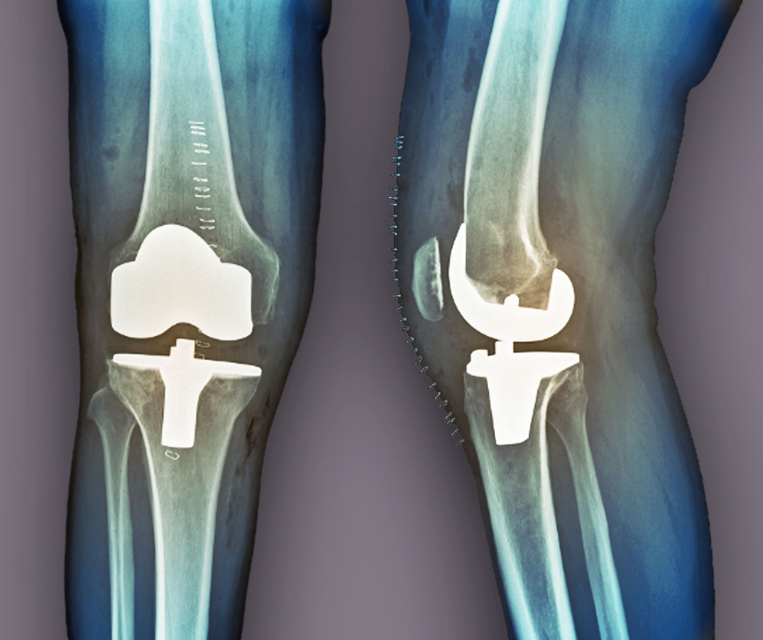 partial knee replacement in Delhi