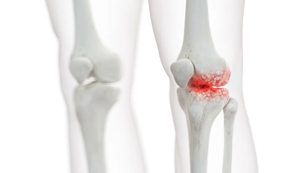 Periprosthetic Joint Infection Treatment in Delhi