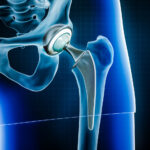 hip replacement complications