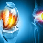 knee replacement complications in delhi