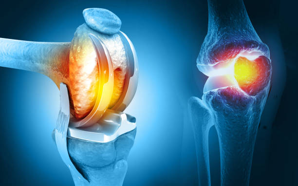 knee replacement complications in delhi