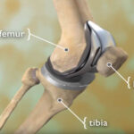 knee replacement surgery