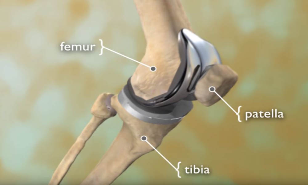 knee replacement surgery